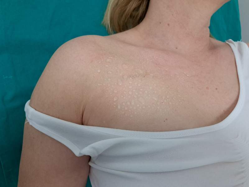 Zašto port a ne centralni venski kateter