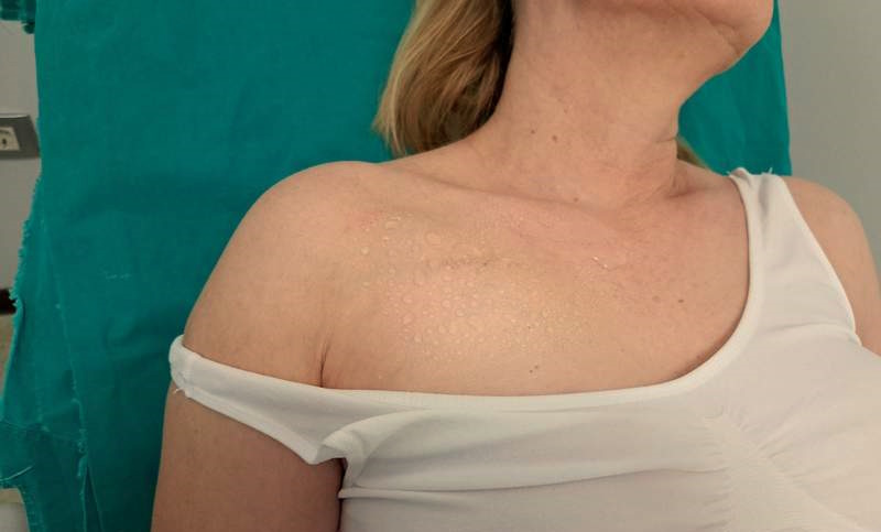 Port za hemoterapiju iskustva