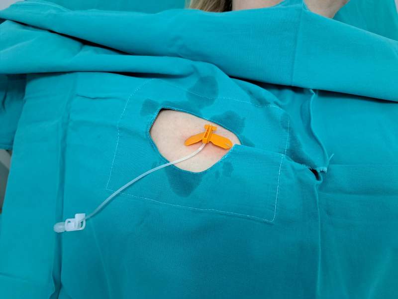 Gde se ugrađuje port za hemoterapiju?