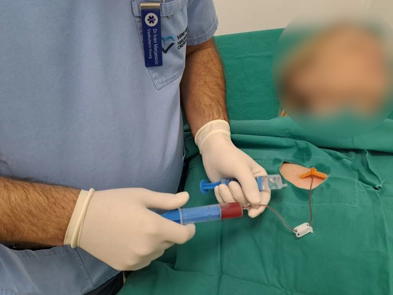 Kako se ugrađuje port za hemoterapiju?